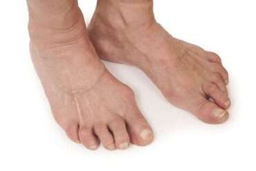 Foot Arthritis Treatment in Action