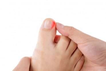 Effective Treatment for Deformed Toenails