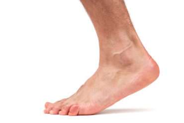 Flat Foot Correction