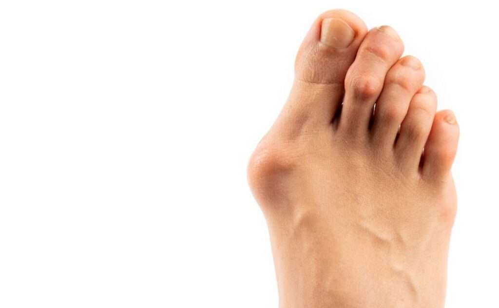 HammerToe Correction Procedure