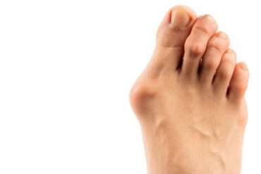 HammerToe Correction Procedure