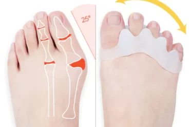 Overlapping Toe Procedure