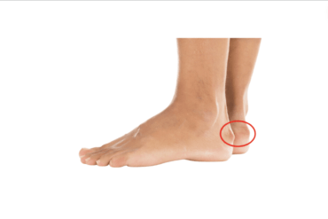 Haglund’s Deformity Surgery