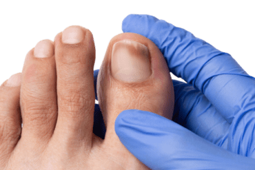 Thickened deformity toenails treatment