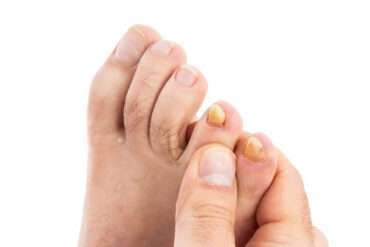 Effective Fungal Nail Infection Treatment